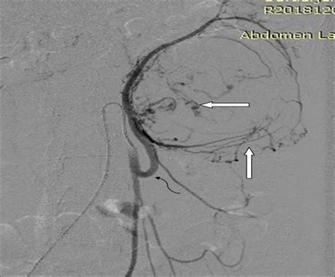 Dsa Image Showing Inferior Mesenteric Selective Angiogram Showing Intra
