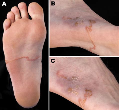 Figure Cutaneous Larva Migrans Acquired In Brittany France Volume
