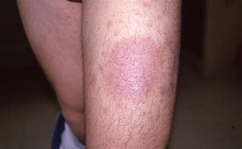 Superficial Fungal Infections Tinea Infection Picture Hellenic