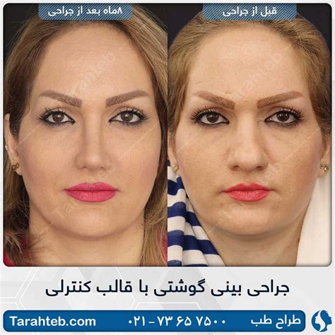 نمونه تصاویر قبل و بعد از جراحی بینی طراح طب