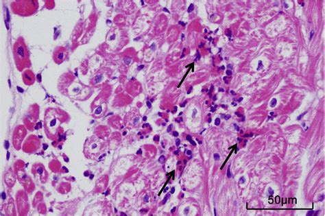 Successfully Treated Eosinophilic Granulomatosis With Polyangiitis