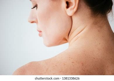 Close Nude Woman Melanoma On Skin Stock Photo Shutterstock