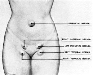 Groin muscles diagram female groin area image of groin in human diagram of groin muscles. Femoral hernia | Medical information, Medical, Fibromyalgia