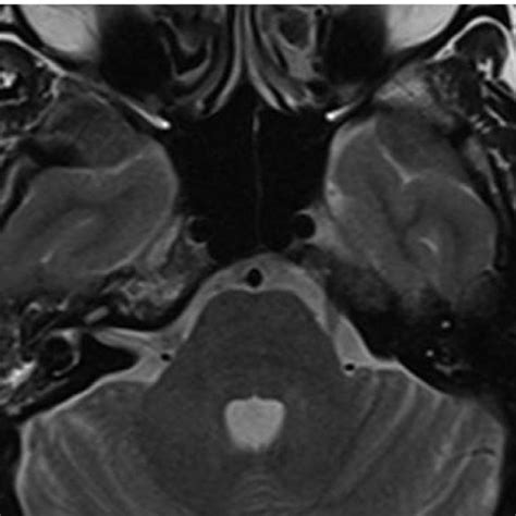 Sagittal T Weighted Image Showing Anterior Pituitary Measuring Mm My