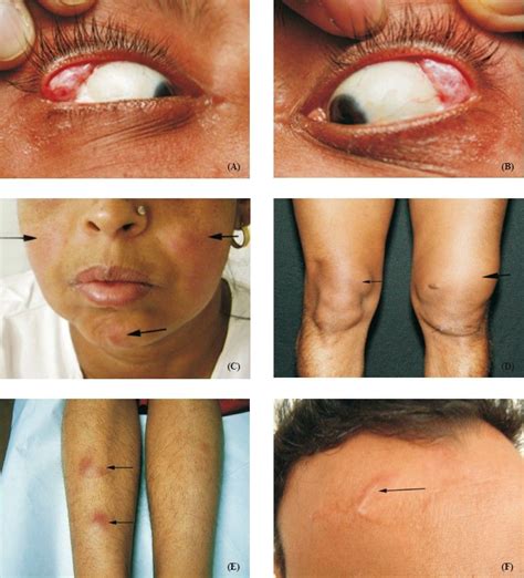 Figure 3 Clinical Images In Sarcoidosis Bilateral Lacrimal Gland