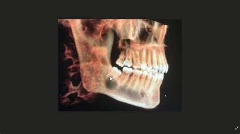 Impacted Wisdom Teeth X Ray View Health Insiders Youtube