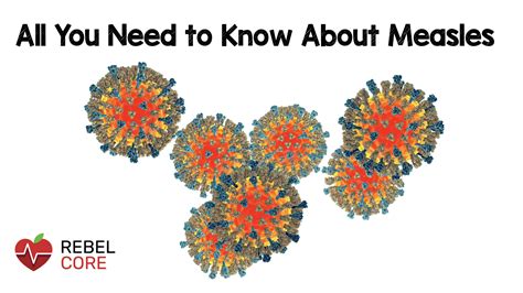 All You Need To Know About Measles Rebel Em Emergency Medicine Blog