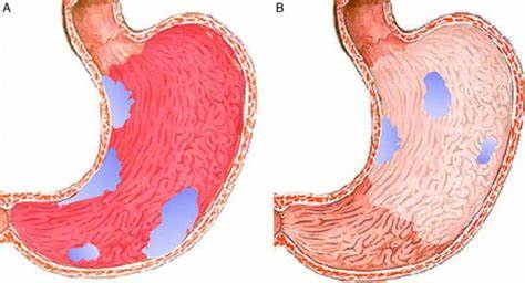 Очаговый гастрит лечения диета Симптомы и лечение очагового атрофического гастрита - Sammedic.ru Симптомы и лечение очагового атрофического гастрита - Sammedic.ru Очаговый гастрит лечения диета