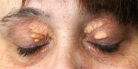 Yellow Spots Around The Eyes Or Xanthelasma Are A Sign Of Bad
