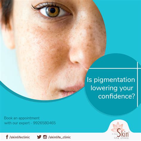 Disorders Of Pigmentation Present As Skin That Is Discolored Blotchy
