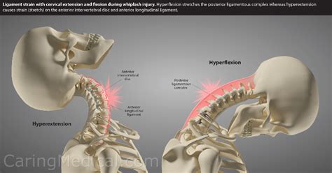 Whiplash And Post Concussion Syndrome In The Ehlers Danlos Syndrome Patient