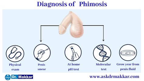 Phimosis Treatment Without Surgery Causes Symptoms Homeopathic