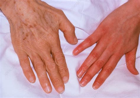 Persons Hand With Iron Deficiency And Healthy Hand Stock Image M108