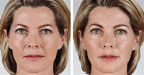 Juvederm Vollure Xc Before And After Photo Cherokee Womens Health