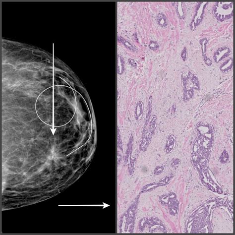 Same Patient As In Figures 28 And 29 Left Sided Mammogram And Cc View