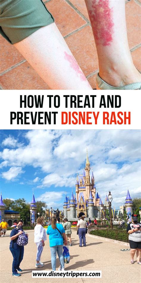 How To Treat And Prevent Disney Rash Disney Trippers In 2021 Disney