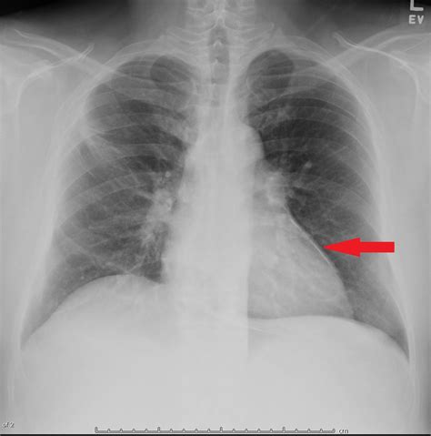 Tuberculous Pericarditis X Ray Wikidoc
