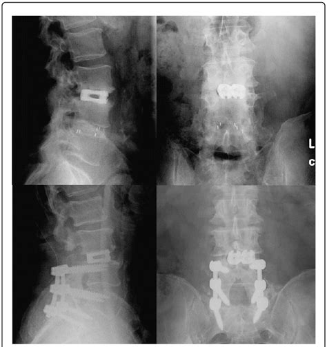 Lumbar X Ray At 12 Months Assessing Fusion At Final Follow Up All