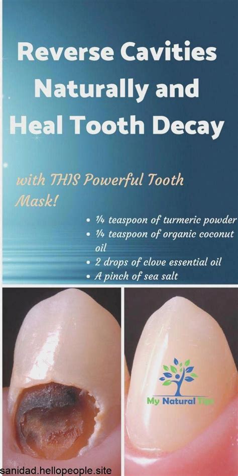 The best way to reverse tooth decay is to combine excellent dental hygiene with some simple dietary changes. How To Heal Tooth Decay And Reverse Cavities Naturally! # ...
