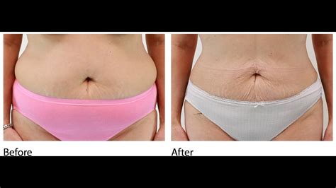 Slimlipo Before And After Pictures Lipolift Youtube