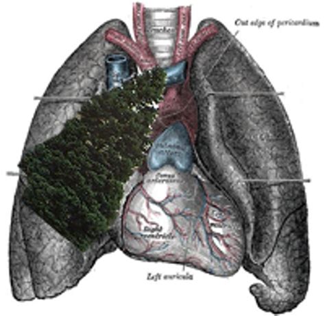 Signs of Spring: Fir Tree Found Growing in Man's Lungs | News Blog