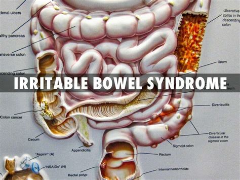 Irritable Bowel Syndrome Irritable Bowel Syndrome Symptoms