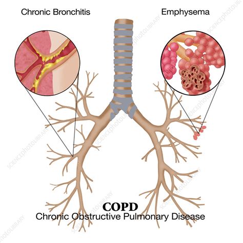 Chronic Obstructive Pulmonary Disease Stock Image C0221057