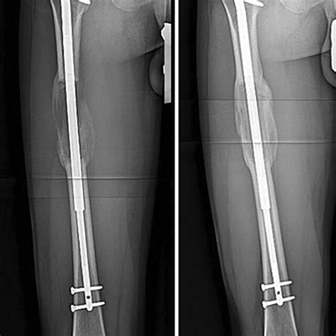 Case Example For Precice ® Femoral Lengthening With Implant Failure