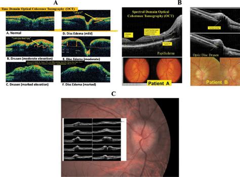 A Time Domain Optical Coherence Tomography Oct Demonstrating Acute