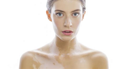 Quali sono le malattie autoimmuni con i rispettivi sintomi. Tutte le sfumature della vitiligine | Pazienti.it