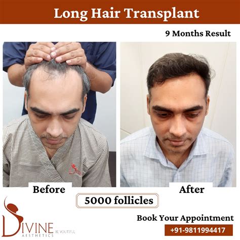 Debunking The Myth Is Hair Transplant Surgery Truly Lifelong