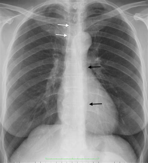 Frontal Chest Radiograph Right Paratracheal Stripe White Arrows And