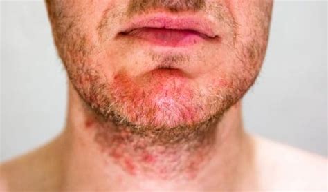 Dry Skin Under Beard Causes Diy Treatments And Help