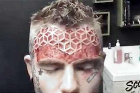 Body Mod Fanatic Has Flesh Carved From His Face To Remove Hated