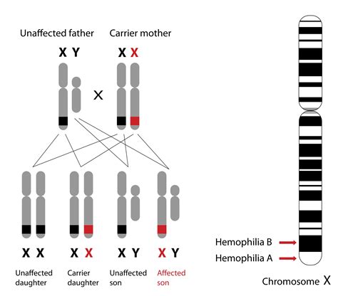 A Hemofilia é Uma Doença Hereditária Recessiva Ligada Askbabe
