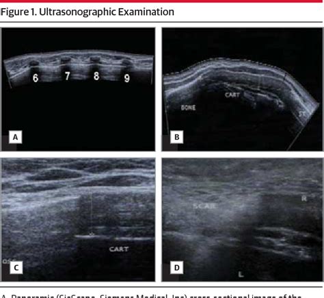 Figure 1 From Ultrasonographic Evaluation Of Calcification Patterns In