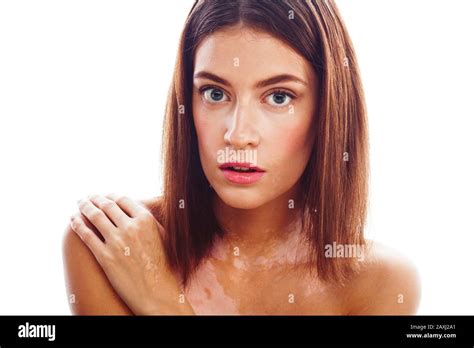 Beautiful Young Brunette Woman With Vitiligo Disease Close Up Isolated