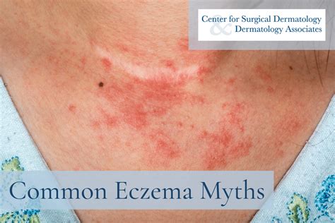 Common Eczema Myths Center For Surgical Dermatology