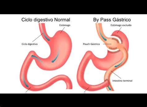 Bypass Gástrico Todo lo que necesitas saber Clínica Centromed