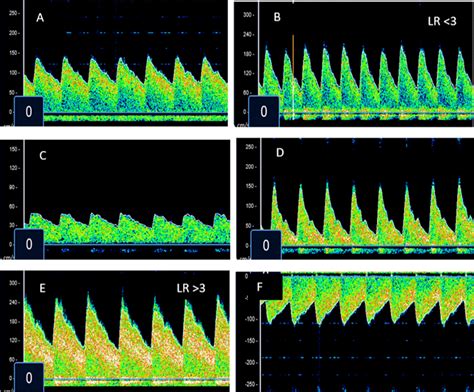 Representative Images Of Transcranial Doppler Ultrasound Phenotypes In