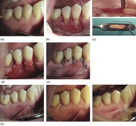 Scielo Brasil Gingival Recession Treatment With Concentrated Growth