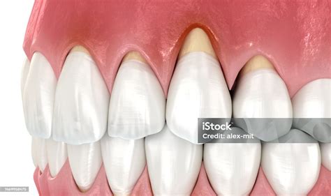 Gingiva Recession 3d Illustration Of Dental Problem Stock Photo