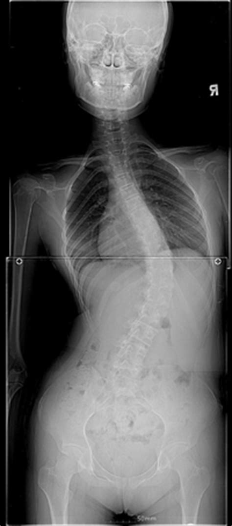 (a.)lordosis (b.)skokiosis (c.)kifo … sis (a.)kifosis (b.)skoliosis (c.)lordosis. Scoliosis & Kyphosis Surgery Bangalore | Neurofibromatosis ...