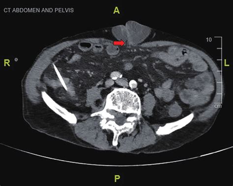 Ct Scan Of Abdomen Revealing An Umbilical Hernia With A Small