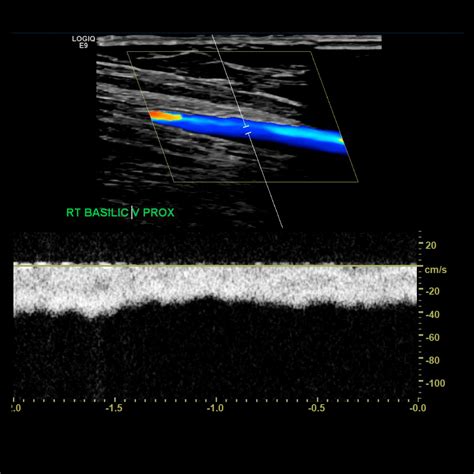 Upper Extremity Venous Doppler Sonographic Tendencies Vascular Ultrasound Medical