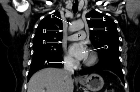 Coronal Computed Tomography Of The Mediastinum The Bmj