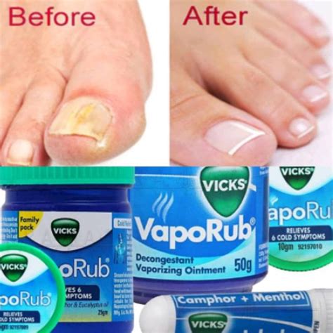 Should i use vicks vaporub if i am pregnant? Vicks vaporub can clear up toenail fungus AND brittle ...