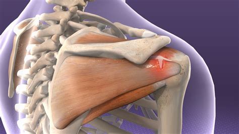 The Rotator Cuff And How It Gets Damaged Lara Physiotherapy