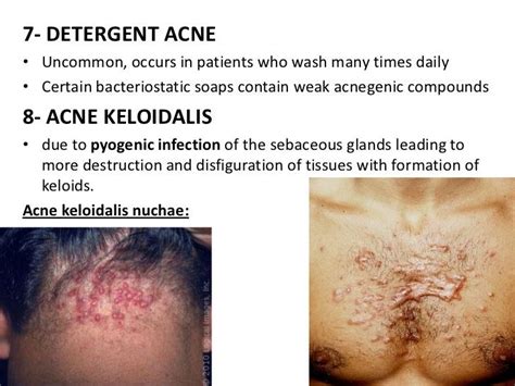 Pin By Rachelle Fire Davis On Diseases Of The Skin Acne Keloidalis