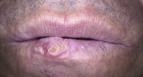 Diagnosing Squamous Cell Carcinoma Of The Lip Using Dermoscopy